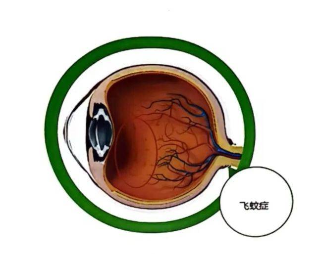 飛蚊癥治療最新突破，開(kāi)啟視界新篇章